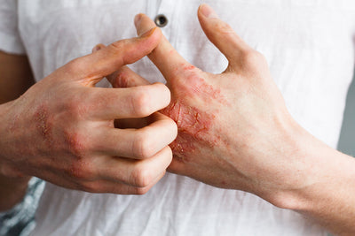 Living with eczema