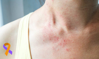 National Eczema Week